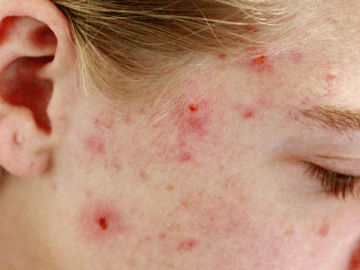 Acne Lifestyle Recommendations